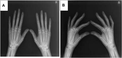 Case report: Clinical, imaging, and genetic characteristics of type B niemann pick disease combined with segawa syndrome diagnosed via dual gene sequencing